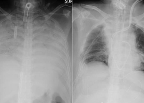 medicii japonezi efectueaza primul transplant de plamani din lume de la un donator viu unui pacient cu covid 19