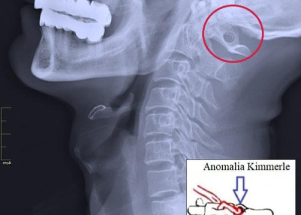 ce este anomalia kimmerle sau sindromul arterei ameteli periodice zgomot in urechi dureri de cap toate pot avea legatura