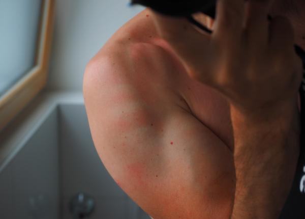 miliaria alergia la caldura ce este si de ce apare remedii naturale