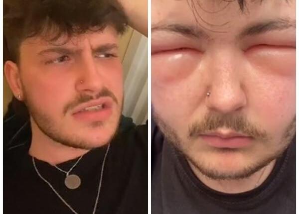 a ajuns la spital dupa ce s a vopsit pe par ce n a respectat un tanar