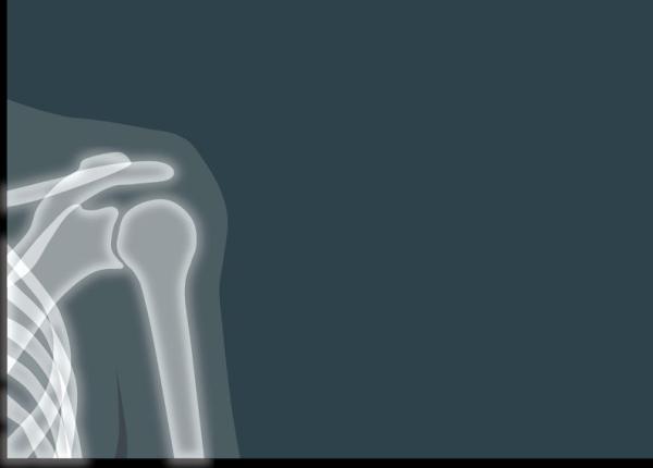 artroplastia de umar inlocuirea articulatiei din umar la persoanele in varsta cum se face si cat de repede se recupereaza