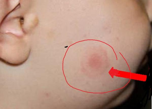 10 lucruri bine de stiu despre muscatura de capusa medicul ciuhodaru atentie la boala cu 1000 de fete