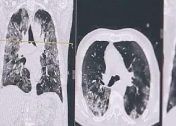 cum arata plamanii afectati de covid medic fara oxigen acesti oameni ar fi murit cu siguranta