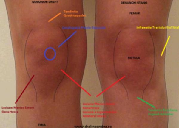 5 cele mai frecvente cauze ale durerilor de genunchi dr alin pandea depistate din timp pot fi tratate