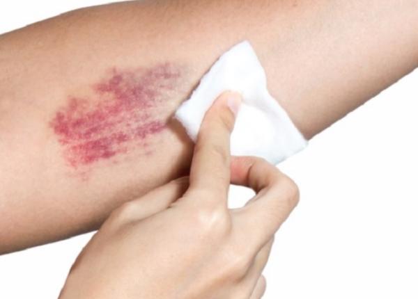 8 remedii naturale pentru vindecarea rapida a unei vanatai