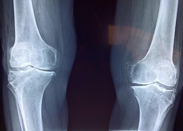 implant personalizat de genunchi imprimat 3d solutie pentru mii de bolnavi de artrita