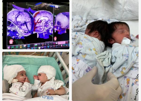 gemeni in varsta de un an care aveau craniile unite operati cu succes interventie chirurgicala rara gemeni in varsta de un an care aveau craniile unite operati cu succes interventie chirurgicala rara