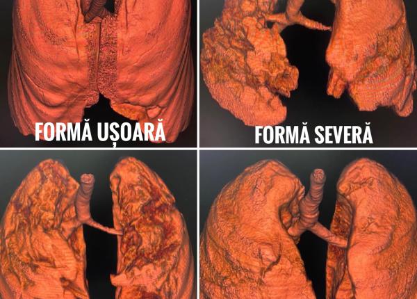 cum arata plamanii bolnavi de covid se vede clar pe tomografii