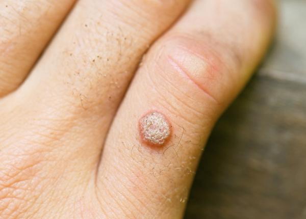 cum sa indepartezi un neg fara durere fara medic fara substante chimice