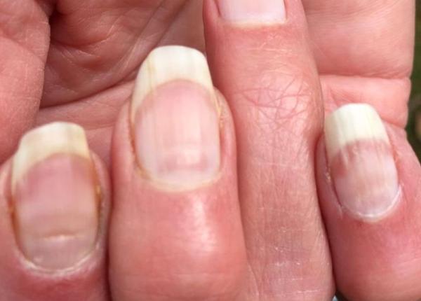 unghiile la control aspectul lor poate trada cancerul de piele