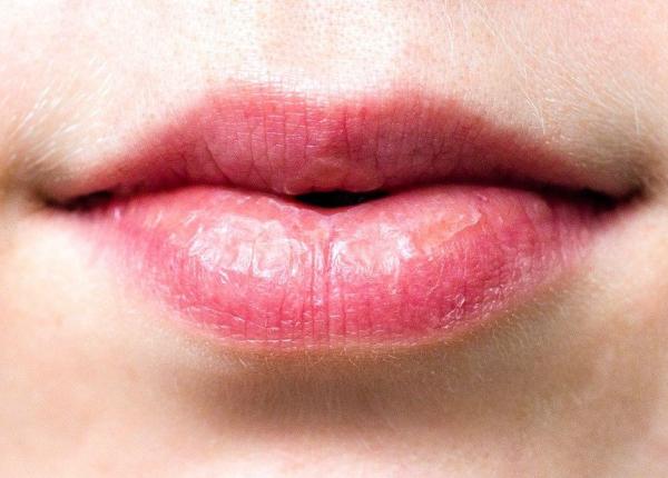 4 remedii naturale pentru buzele crapate si uscate