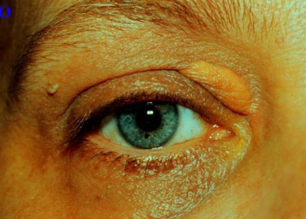 colesterolul cum tradeaza pielea nivelul prea mare