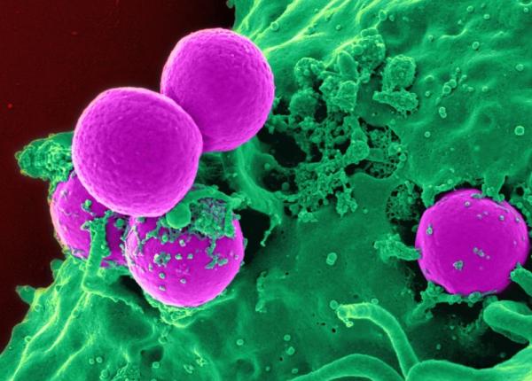 cancerul de prostata si speranta de viata prof dr petrisor geavlete in europa este de peste 80 de ani la noi 73 de ani