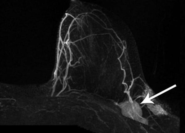adaugarea de ultrasunete la mamografie imbunatateste rata de detectare a cancerului