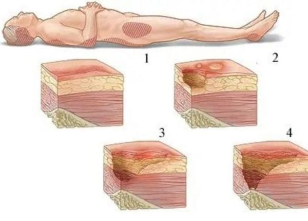 escarele ce sunt si de ce apar explicatiile unui medic