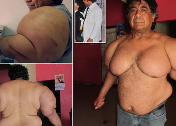 fenomenul ciudat care l a facut pe un barbat sa ia in greutate 27 de kilograme in doar cateva minute