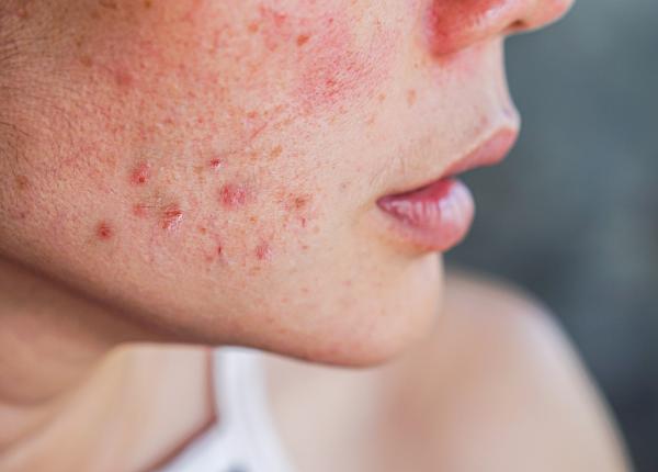 4 obiceiuri zilnice care iti vor face cosuri pe fata