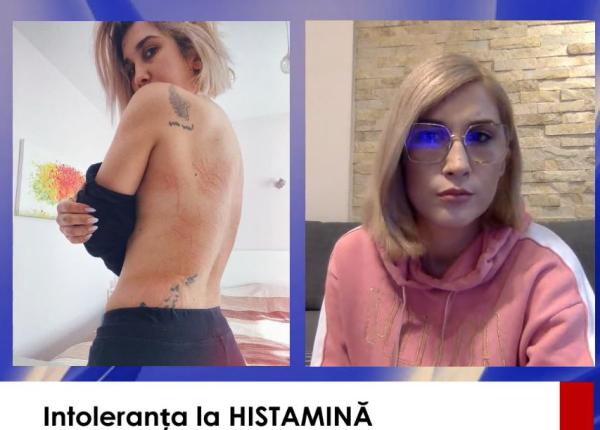 medicul rares simu despre intoleranta la histamina boala cu care se confrunta adda nu mai e o afectiune rara