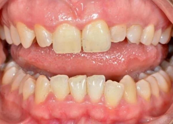 ai afectiuni gingivale atentie mare risti sa faci o boala grava