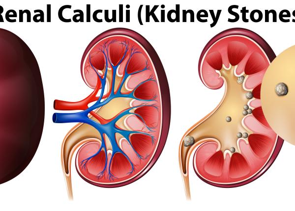 piatra la rinichi simptome tratament reapare 5 ani