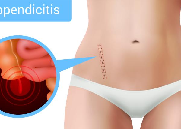 apendicita la copii cauze simptome si tratament
