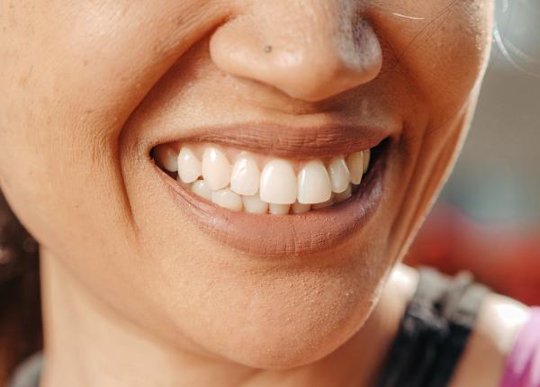 albirea dintilor cand se face si cat dureaza cine nu are voie sa o faca