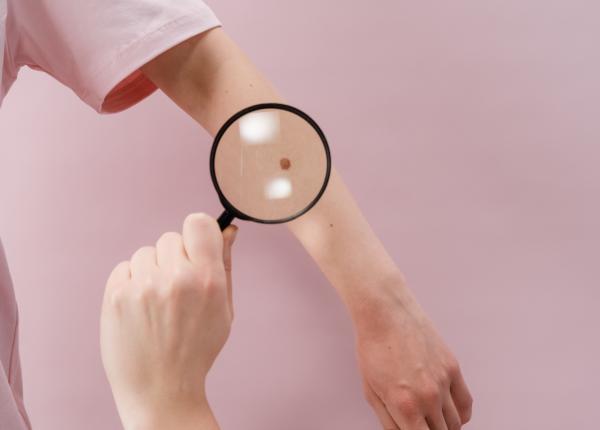 alunitele legatura cu melanomul cand trebuie indepartate