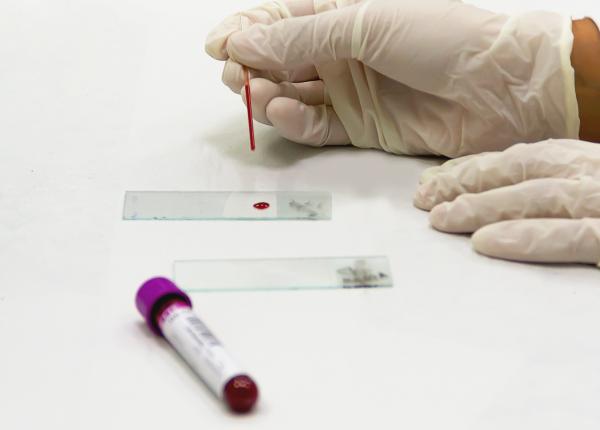 trombofilia simptome diagnostic si tratament poate cauza avort trombofilia simptome diagnostic si tratament poate cauza avort