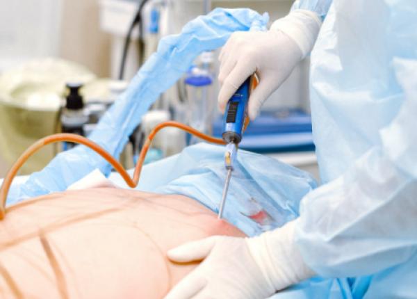 chirurgia laparoscopica patru avantaje importante dr horia cioflan cu cat taietura e mai mica cu atat durerea e mai mica