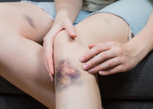 de ce apar vanataile si cum putem scapa usor de ele pot fi semnul unor afectiuni