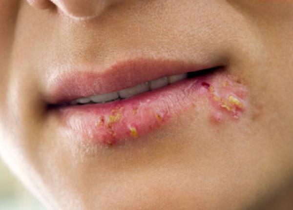 herpesul cauze si simptome stresul poate declansa activarea sa
