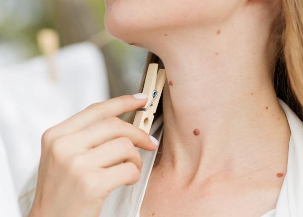 alunitele cum si cand devin cancerigene si cine este expus alunitele cum si cand devin cancerigene si cine este expus