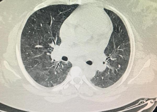 pneumonia comunitara crestere de cazuri in spitale dr geru despre simptome transmitere foarte ridicata 15prc dintre pacienti mor