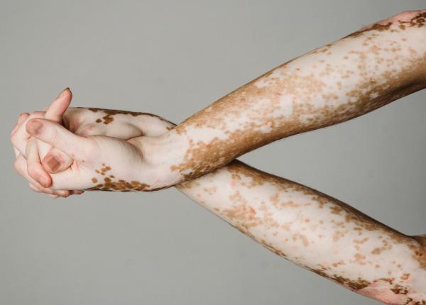 vitiligo afectiunea care nu pune in pericol viata dar o schimba apare inainte de 30 de ani