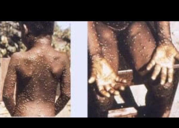 variola maimutei monkeypox adevarul care pot provoca pandemie nostradamus variola maimutei monkeypox adevarul care pot provoca pandemie nostradamus