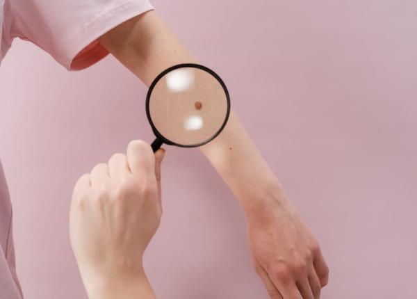 pete pe piele sau arsura semnele unui cancer de piele verifica abc ul dermatologic foarte popular si usor de retinut