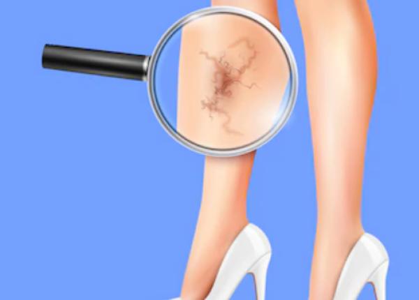 boala varicoasa afectiunea care nu se vindeca care sunt semnele la care sa fii atent