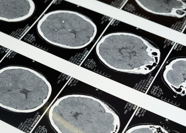 medicamentul care ar putea trata bolile creierului alzheimer autism schizofrenie