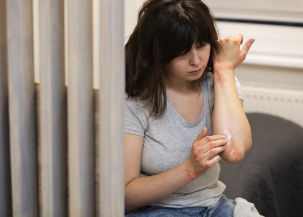 care e diferenta dintre variola maimutei varicela si variola cele doua semne la care sa fii atent