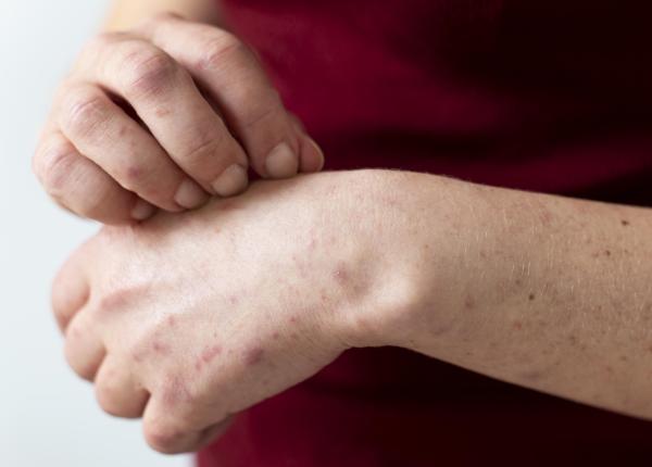 gripa tomatelor noua boala misterioasa similara cu variola maimutei eruptii pe tot corpul foarte dureroase si contagioase se recomanda izolarea