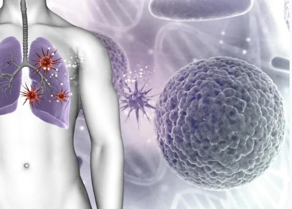 tehnica ce omoara cancerul pulmonar se necrozeaza in sase luni nu se mai vede deloc pe vremuri chirurgia clasica inlocuia intregul plaman