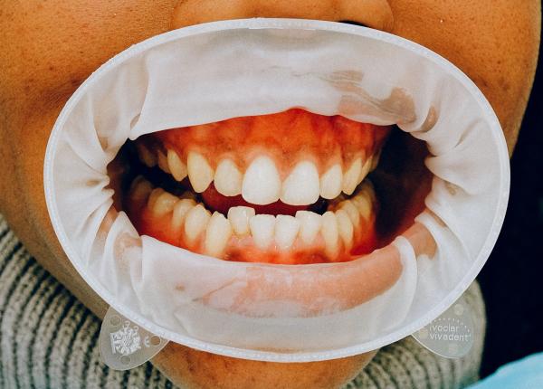 ce inseamna scrasnirea dintilor ce afectiuni ascunde bruxismul