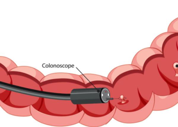 cand se face colonoscopia florentina ionita radu acum se face sub anestezie pacientul nu stie nimic