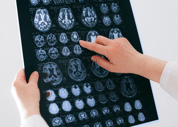 bolile cardiovasculare pot cauza alzheimer colesterolul are un rol negativ