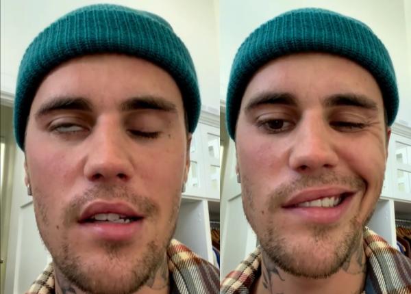 justin bieber paralizat pe jumatate de fata ce este sindromul ramsay hunt pierderea auzului