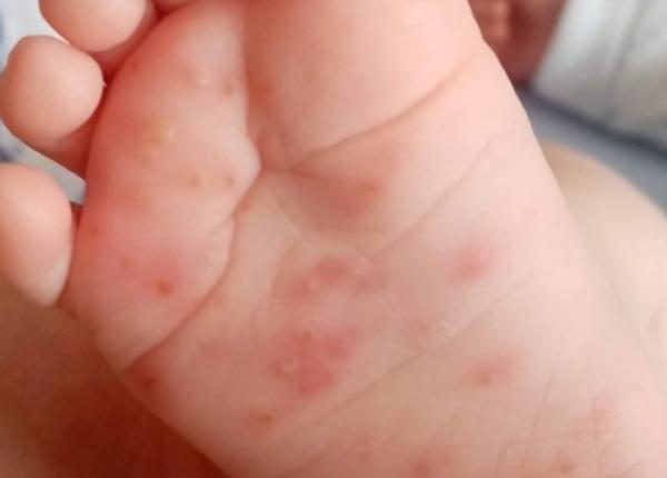 sindromul mana picior gura boala virala chinuitoare simptome izoare