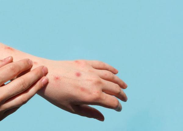 variola maimutei al patrulea caz confirmat in romania