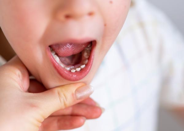 eruptia dentara simptome si tratament medic nu trebuie sa subestimam prezenta febrei