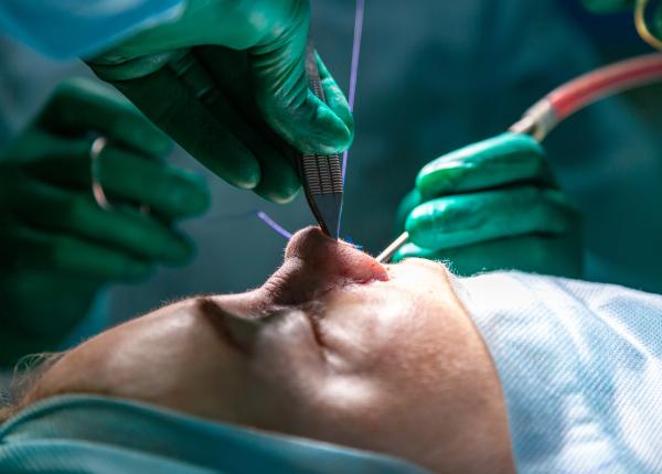 rinoplastia interventia de corectare a nasului cand este indicata rinoplastia interventia de corectare a nasului cand este indicata