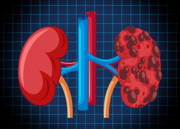 sindromul alport boala de rinichi duce la pierderea auzului si vazului sindromul alport boala de rinichi duce la pierderea auzului si vazului